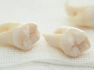 智齒疼了，這牙非拔不可嗎？