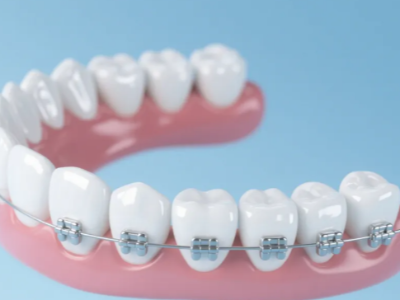 想做牙齒矯正，哪種方案更適合你？
