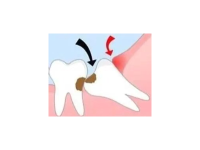 吃完飯后老塞牙？別大意！這可能是你的牙齒在報(bào)警