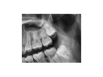 既然「智齒」不宜久留，為什么不能一次性拔掉？