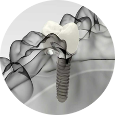 術前研究、模擬提升種植成功率