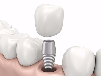 在承德哪家口腔醫(yī)院口腔種植齒好一點(diǎn)，惟德口腔醫(yī)院值得您的選擇