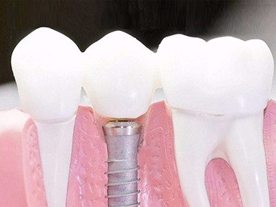 在承德口腔種植齒需要多少錢？惟德口腔一一為您道來(lái)