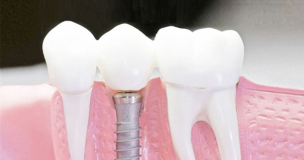 在承德口腔種植牙齒需要多少錢？惟德口腔一一為您道來(lái)